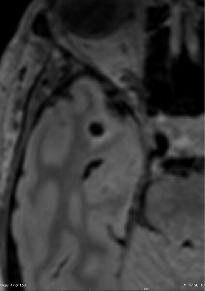 File:Anterior temporal lobe perivascular space (Radiopaedia 40946-43650 C 8).jpg