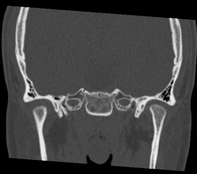 File:Antrochoanal polyp (Radiopaedia 21894-21868 Coronal bone window 36).jpg