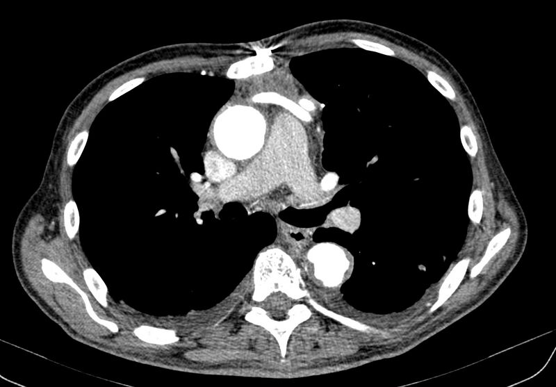 File:Aortic arch saccular aneurysm (Radiopaedia 19430-19457 B 17).jpg