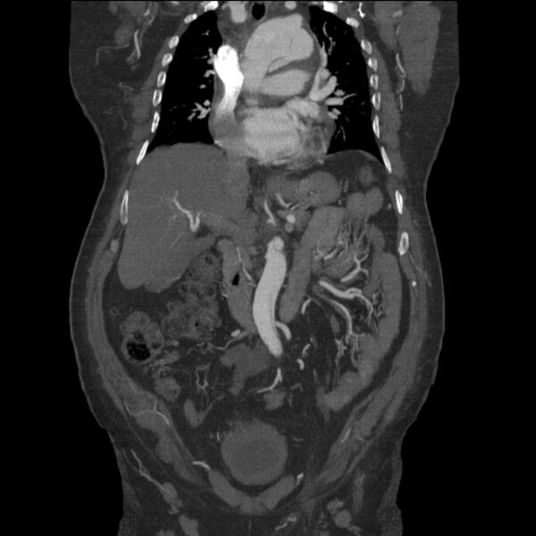 File:Aortic dissection (Radiopaedia 28802-29105 B 13).jpg