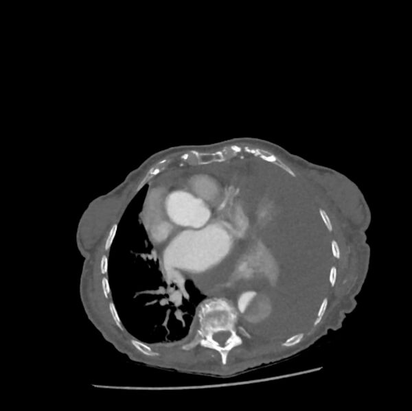 File:Aortic dissection (Radiopaedia 68763-78691 A 33).jpeg