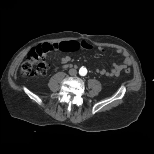 File:Aortic dissection with rupture into pericardium (Radiopaedia 12384-12647 A 70).jpg