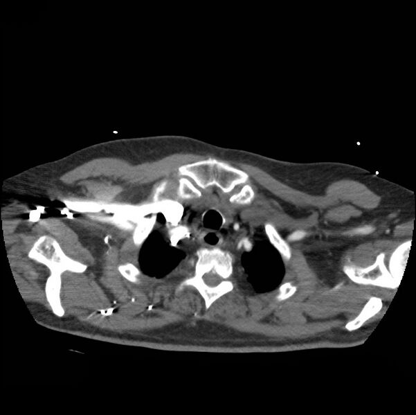 File:Aortic dissection with rupture into pericardium (Radiopaedia 12384-12647 A 8).jpg