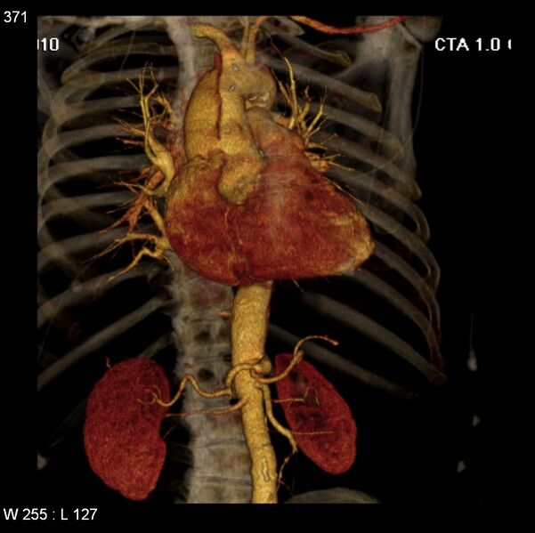 File:Aortic dissection with rupture into pericardium (Radiopaedia 12384-12647 C+ arterial phase 3).jpg