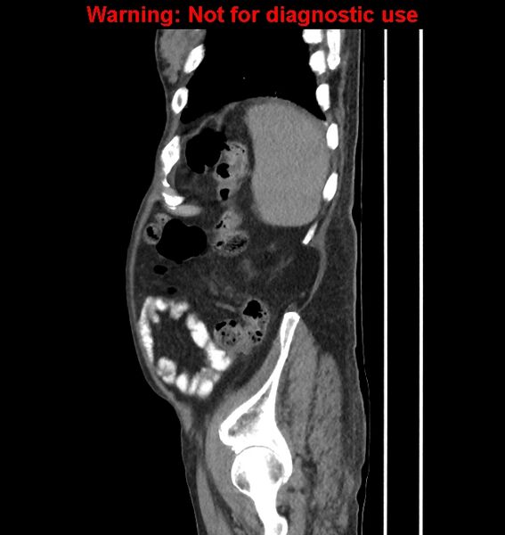File:Aortic graft infection (Radiopaedia 44979-48907 C 14).jpg