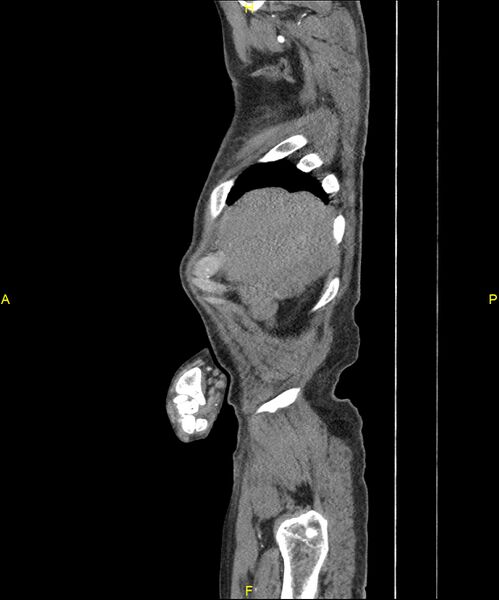 File:Aortoenteric fistula (Radiopaedia 84308-99603 C 33).jpg
