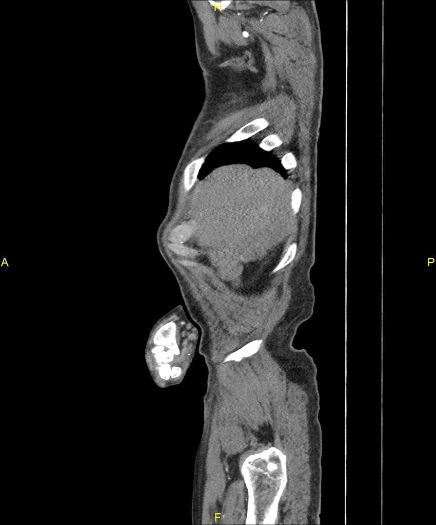 Aortoenteric fistula (Radiopaedia 84308-99603 C 33).jpg