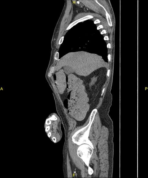 File:Aortoenteric fistula (Radiopaedia 84308-99603 C 67).jpg