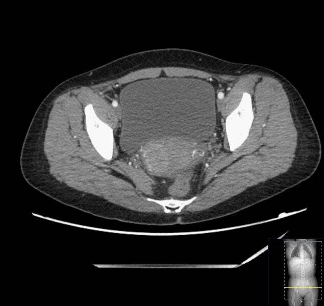 File:Appendicitis (CT angiogram) (Radiopaedia 154713-127660 Axial 42).jpg