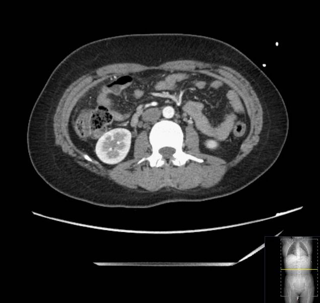 File:Appendicitis (CT angiogram) (Radiopaedia 154713-127660 Axial 89).jpg