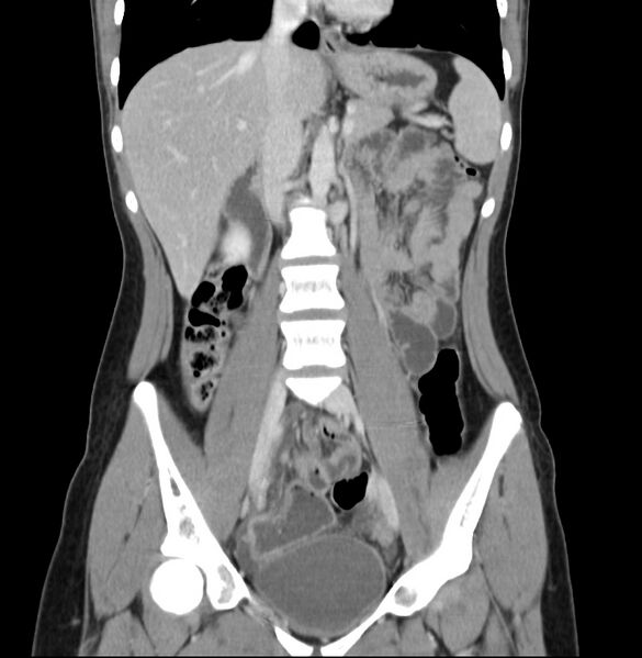 File:Appendicitis and incidental bicornuate uterus (Radiopaedia 22833-22853 D 20).jpg