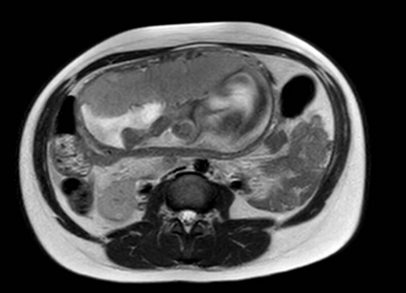 File:Appendicitis in gravida (MRI) (Radiopaedia 89433-106395 Axial T2 32).jpg