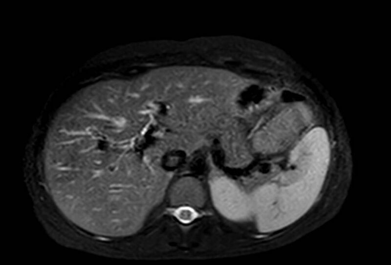 File:Appendicitis in gravida (MRI) (Radiopaedia 89433-106395 Axial T2 SPAIR 17).jpg