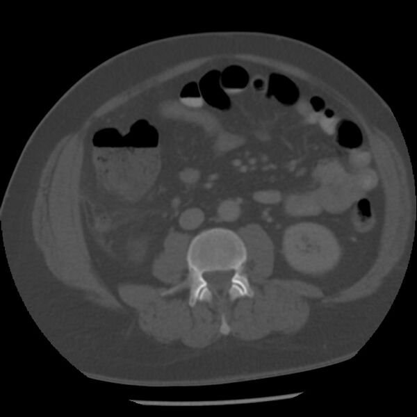 File:Appendicitis with perforation (Radiopaedia 35790-37342 Axial bone window 27).jpg