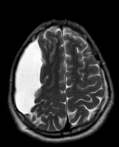 File:Arachnoid cyst- extremely large (Radiopaedia 68741-78451 Axial T2 21).jpg