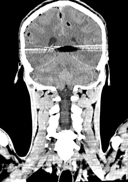 File:Arrow injury to the brain (Radiopaedia 72101-82607 Coronal non-contrast 51).jpg