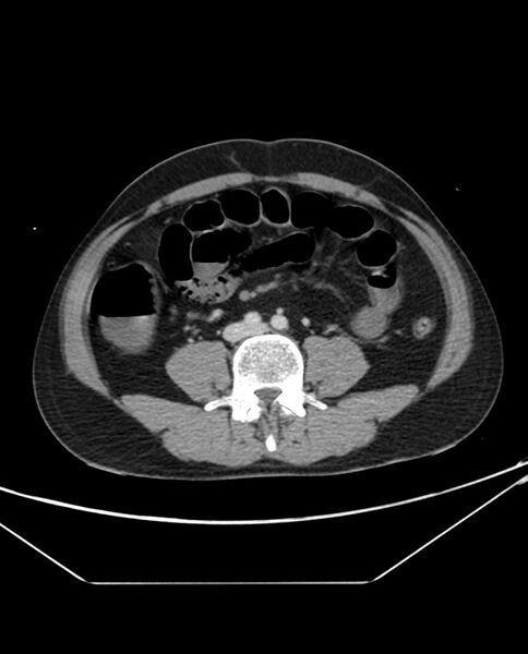 File:Arterial occlusive mesenteric ischemia (Radiopaedia 84641-100054 A 72).jpg