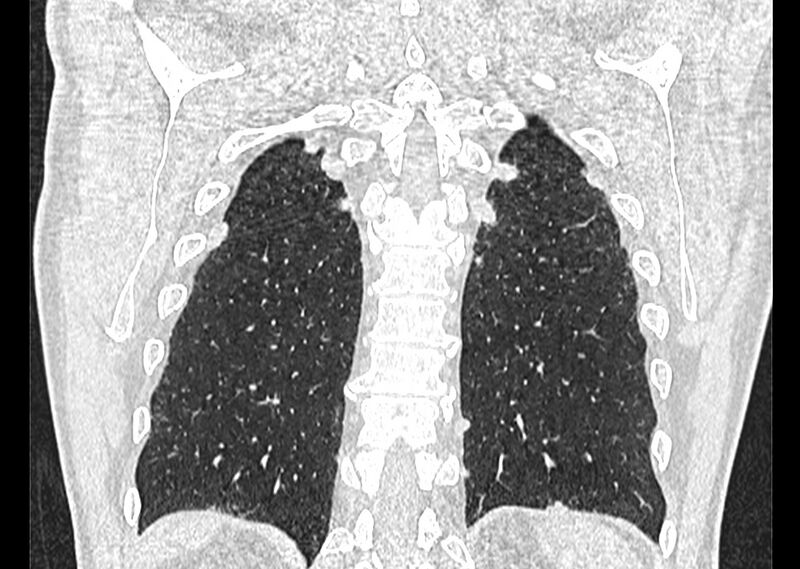 File:Asbestos pleural placques (Radiopaedia 57905-64872 Coronal lung window 242).jpg
