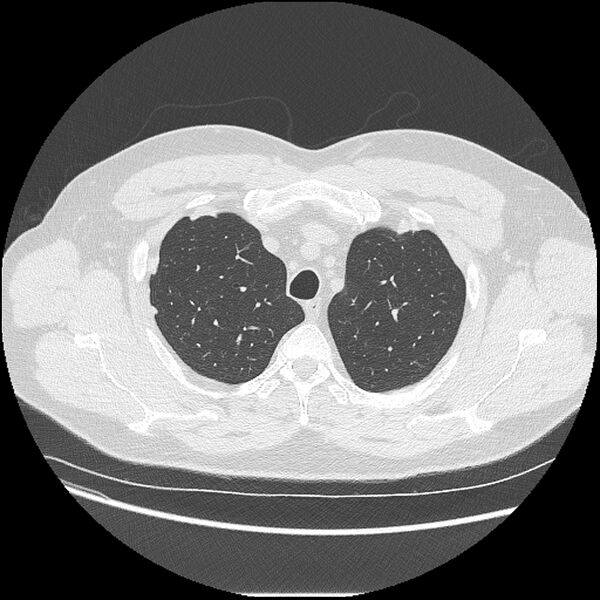 File:Asbestosis (Radiopaedia 45002-48961 Axial lung window 10).jpg