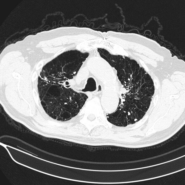 File:Aspergilloma (Radiopaedia 24521-24804 Axial lung window 5).jpg