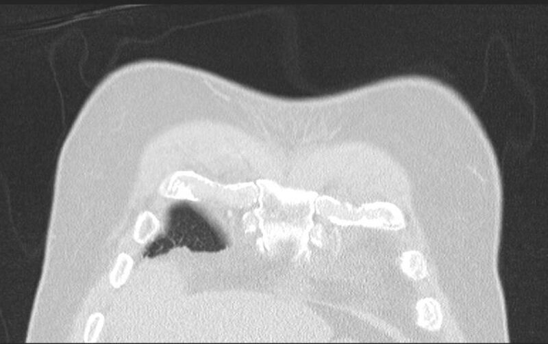 File:Aspirated tooth (Radiopaedia 28584-28844 Axial lung window 25).jpg