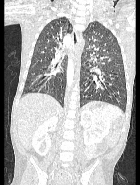 File:Asplenia syndrome (Radiopaedia 73083-83792 Coronal lung window 93).jpg