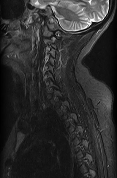 File:Astrocytoma - spinal cord (Radiopaedia 69769-79758 Sagittal STIR 10).jpg