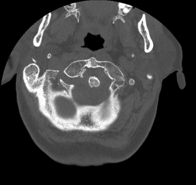 File:Atlanto-occipital assimilation with basilar invagination (Radiopaedia 70122-80188 Axial bone window 15).jpg
