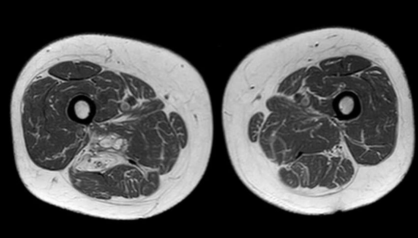 Atypical lipomatous tumor - thigh (Radiopaedia 68975-78734 Axial T1 56).jpg