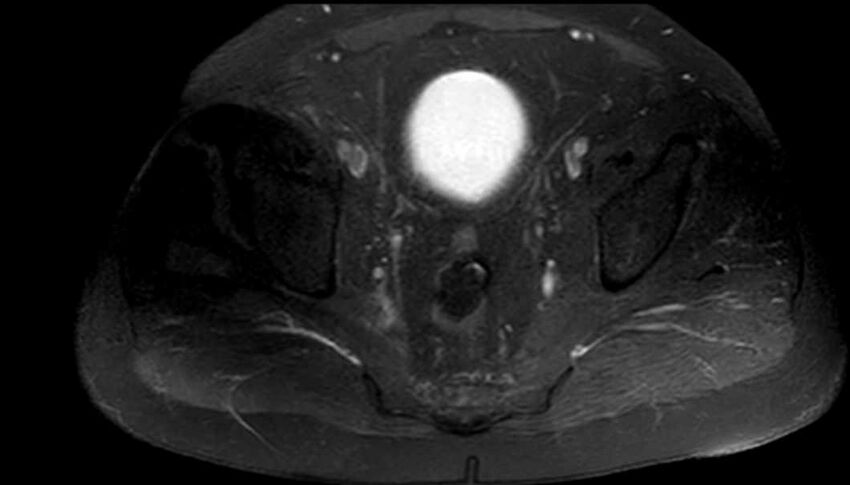 Atypical lipomatous tumor - thigh (Radiopaedia 68975-78734 Axial T1 C+ fat sat 100).jpg