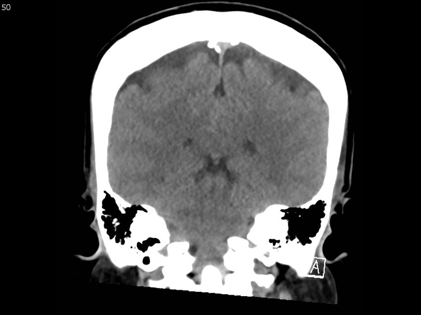 Atypical meningioma - intraosseous (Radiopaedia 64915-73867 B 49).jpg