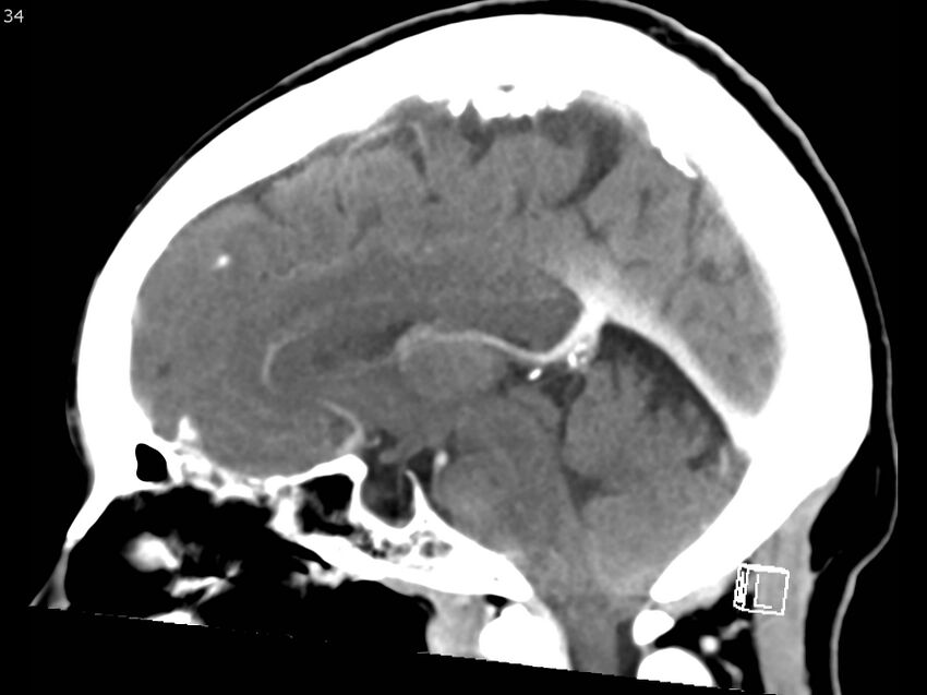 Atypical meningioma - intraosseous (Radiopaedia 64915-73867 F 33).jpg