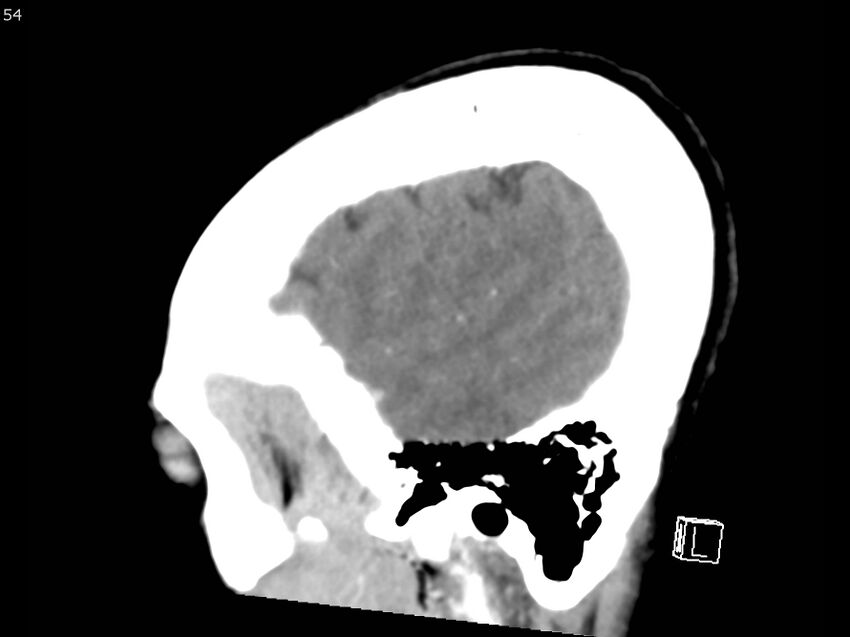 Atypical meningioma - intraosseous (Radiopaedia 64915-73867 F 53).jpg