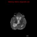 Atypical teratoid rhabdoid tumor (Radiopaedia 10712-11183 Axial DWI 9).jpg