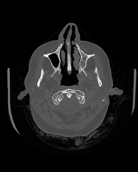 File:Automastoidectomy with labyrinthine fistula (Radiopaedia 84143-99411 Axial non-contrast 46).jpg