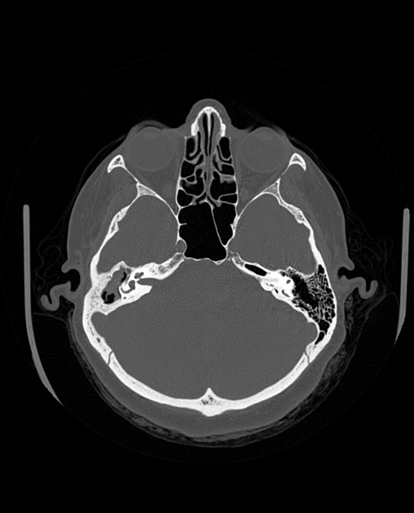Automastoidectomy with labyrinthine fistula (Radiopaedia 84143-99411 Axial non-contrast 92).jpg