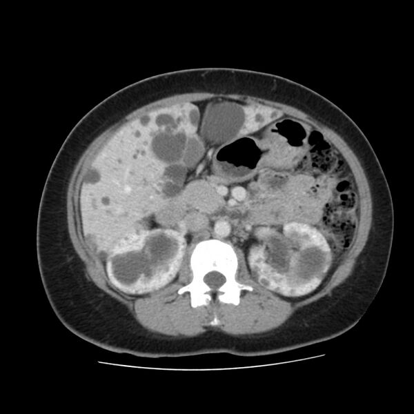 File:Autosomal dominant polycystic kidney disease (Radiopaedia 23061-23093 C 26).jpg