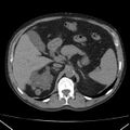 Autosomal dominant polycystic kidney disease (Radiopaedia 36539-38101 Axial non-contrast 24).jpg