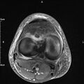 Avulsion fracture of the fibular head (Radiopaedia 74804-85808 Axial PD fat sat 22).jpg