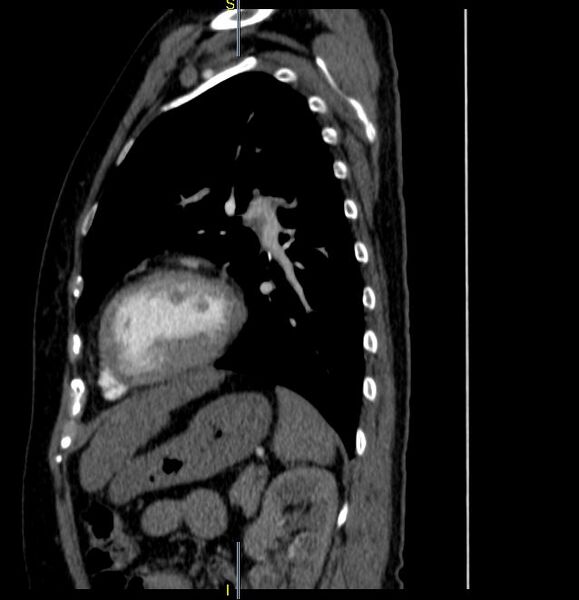 File:Azygos vein aneurysm (Radiopaedia 77824-90130 D 11).JPG