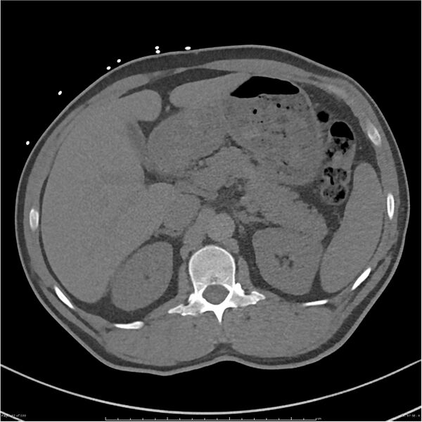 File:Azygos venous system anatomy (CT pulmonary angiography) (Radiopaedia 25928-26077 Axial C+ CTPA 97).jpg