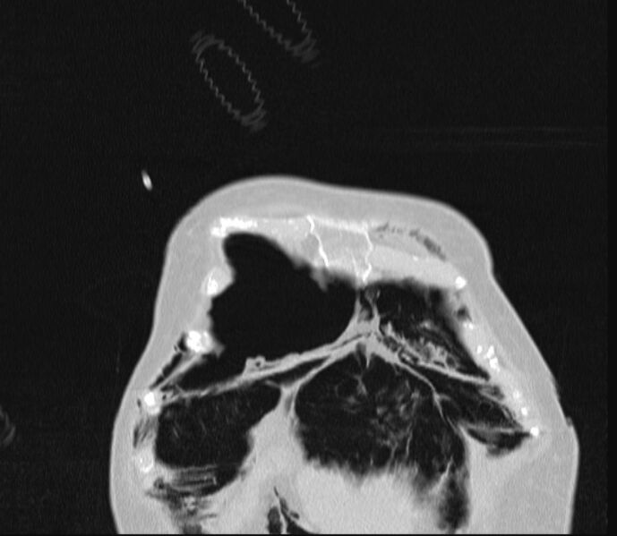 File:Barotrauma due to mechanical ventilation (Radiopaedia 28079-28336 Coronal lung window 12).jpg