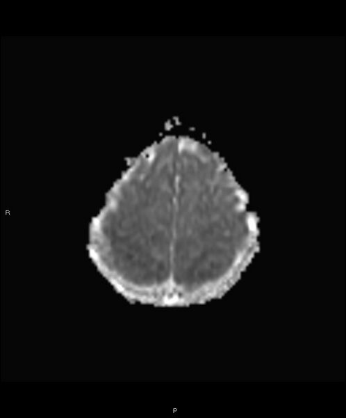 File:Basal ganglia and parenchymal ischemia (Radiopaedia 45818-50084 Axial ADC 19).jpg