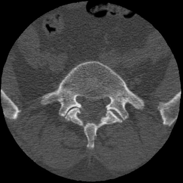 File:Bertolotti syndrome (Radiopaedia 24864-25128 Axial bone window 5).jpg