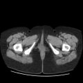 Bicornuate uterus- on MRI (Radiopaedia 49206-54296 Axial non-contrast 18).jpg