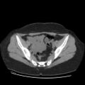 Bicornuate uterus- on MRI (Radiopaedia 49206-54296 Axial non-contrast 6).jpg