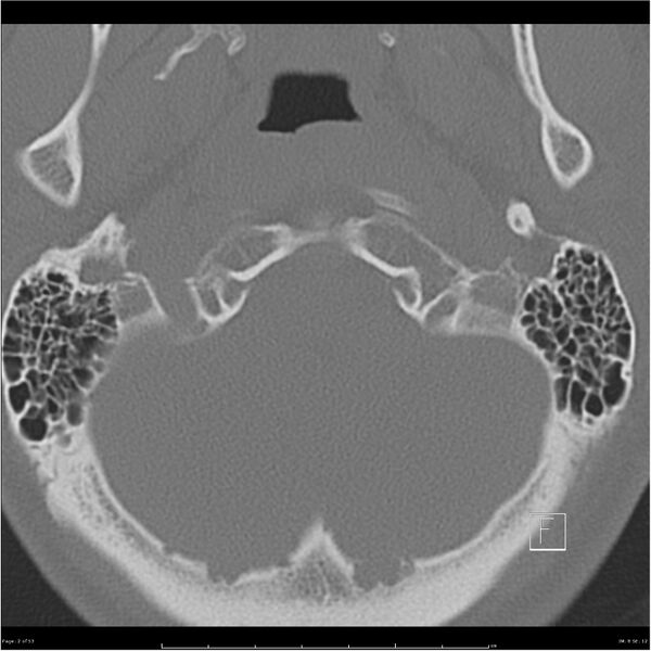 File:Bilateral cervical ribs (Radiopaedia 25868-26017 Axial bone window 2).jpg
