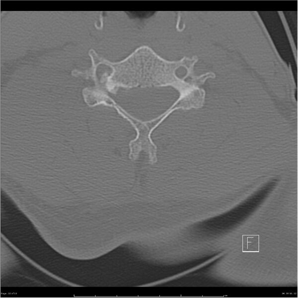 File:Bilateral cervical ribs (Radiopaedia 25868-26017 Axial bone window 32).jpg
