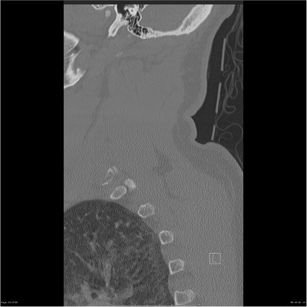 File:Bilateral cervical ribs (Radiopaedia 25868-26017 Sagittal bone window 65).jpg