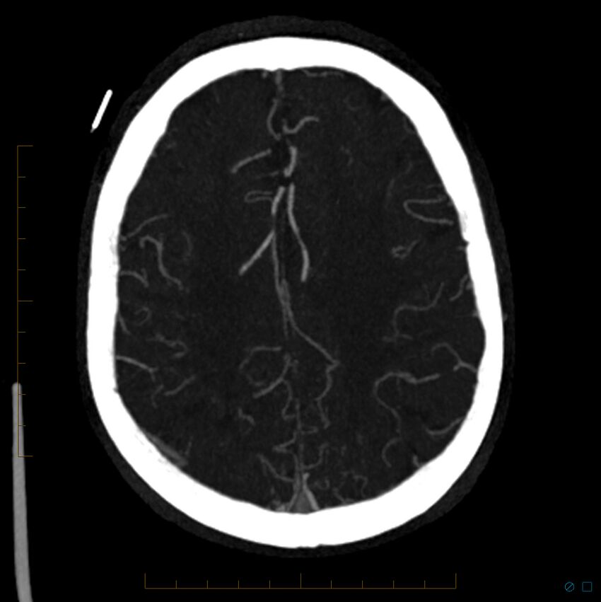 Bilateral chronic common carotid occlusion (Radiopaedia 50849-56362 D 9).jpg